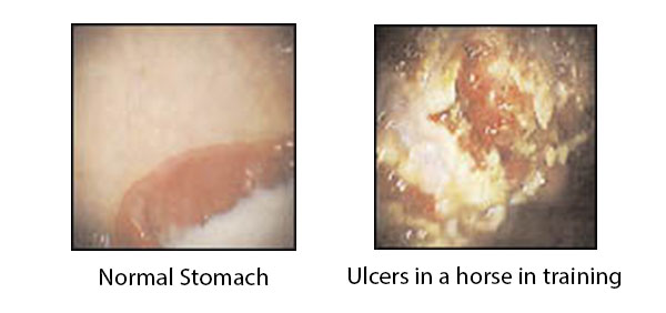 stomach_ulcers